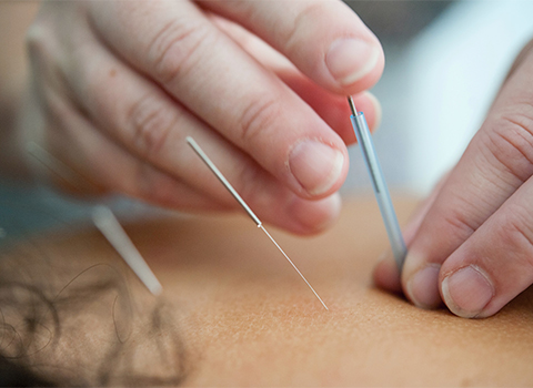 Imagen de un tratamiento de fisioterapia a través de acupuntura para el manguito rotador